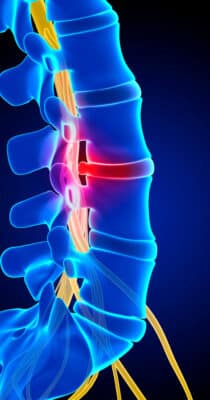 hernie discale lombaire